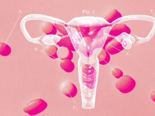El Síndrome de Ovario Poliquístico: Difícil de detectar y tratar casi un siglo después