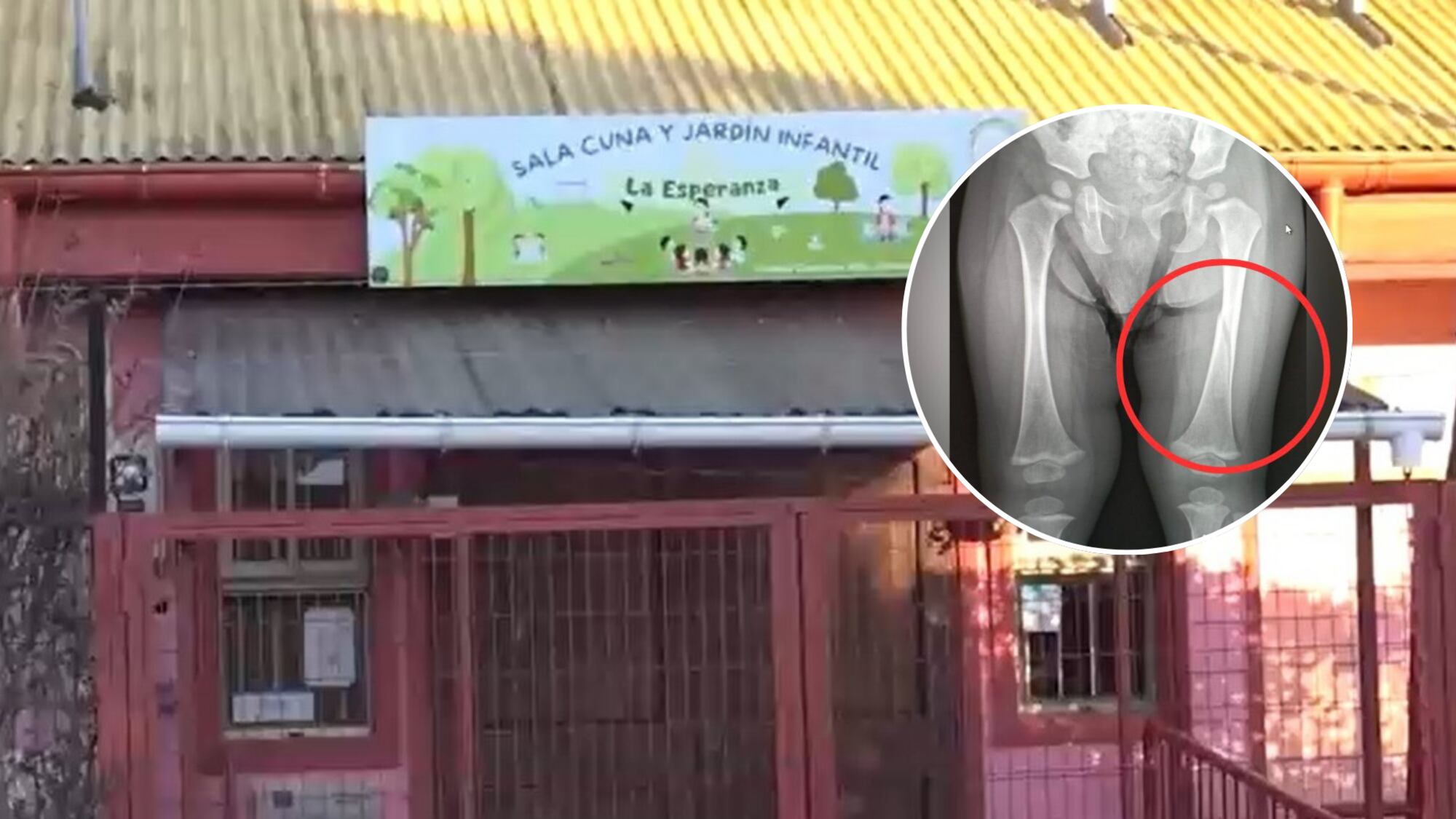 Madre denuncia negligencia tras recibir a su hijo con fractura de fémur desde jardín infantil en Chiguayante