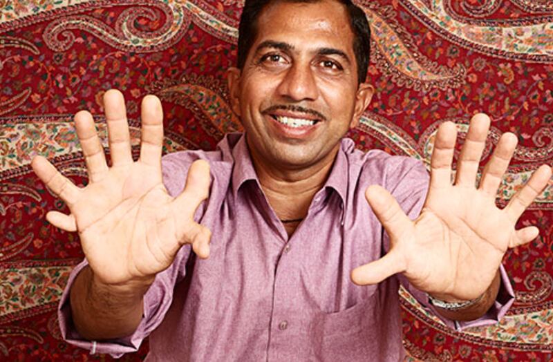 Hombre en India ingresó al Libro Guinness de los Récords por una curiosidad: tiene 28 dedos