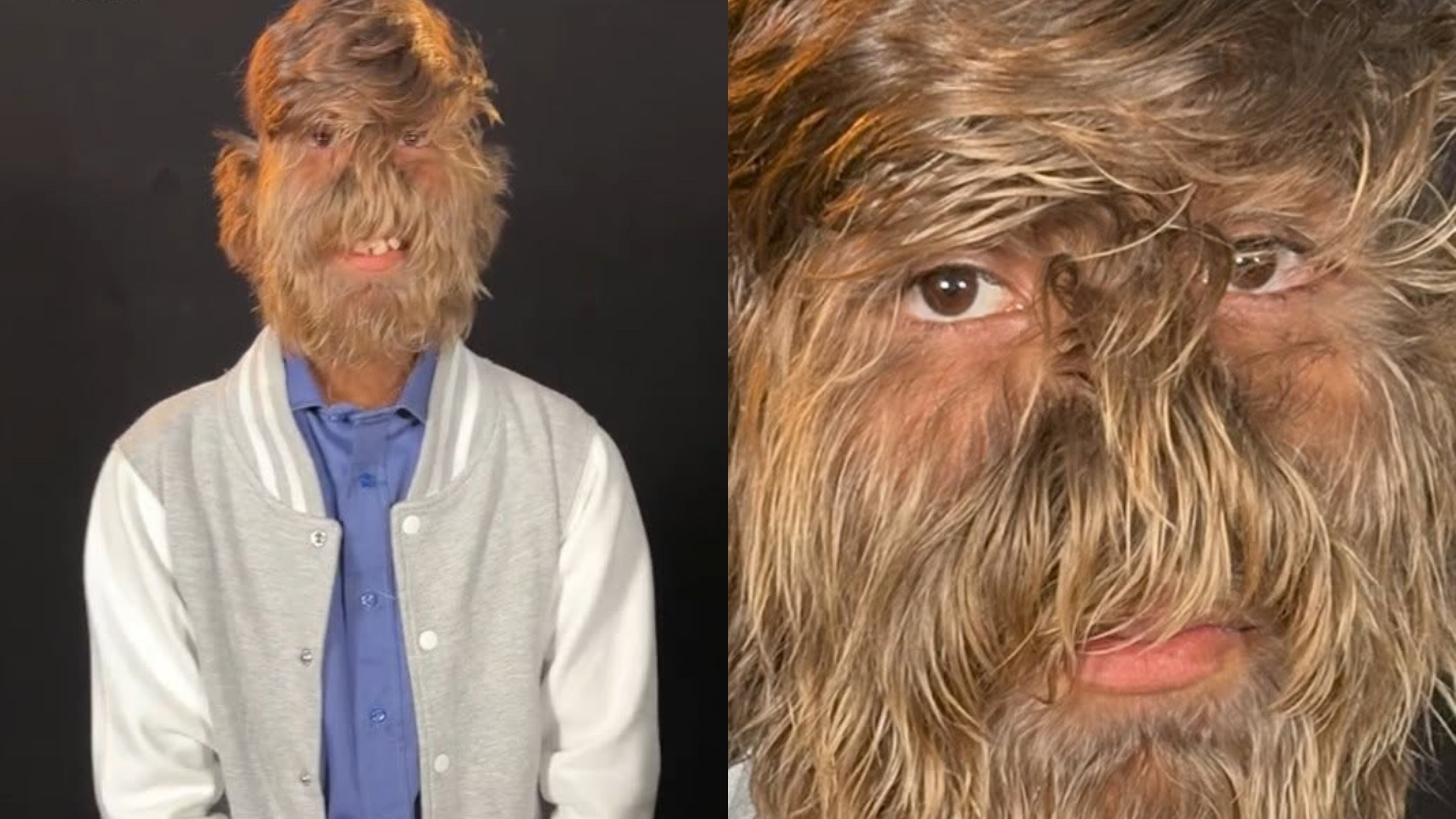 Joven de India obtiene récord Guinness por tener el rostro con más vello facial del mundo