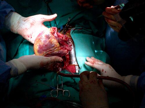 No era un mal de amores: vivió cuatro años con un mondadientes clavado en el corazón