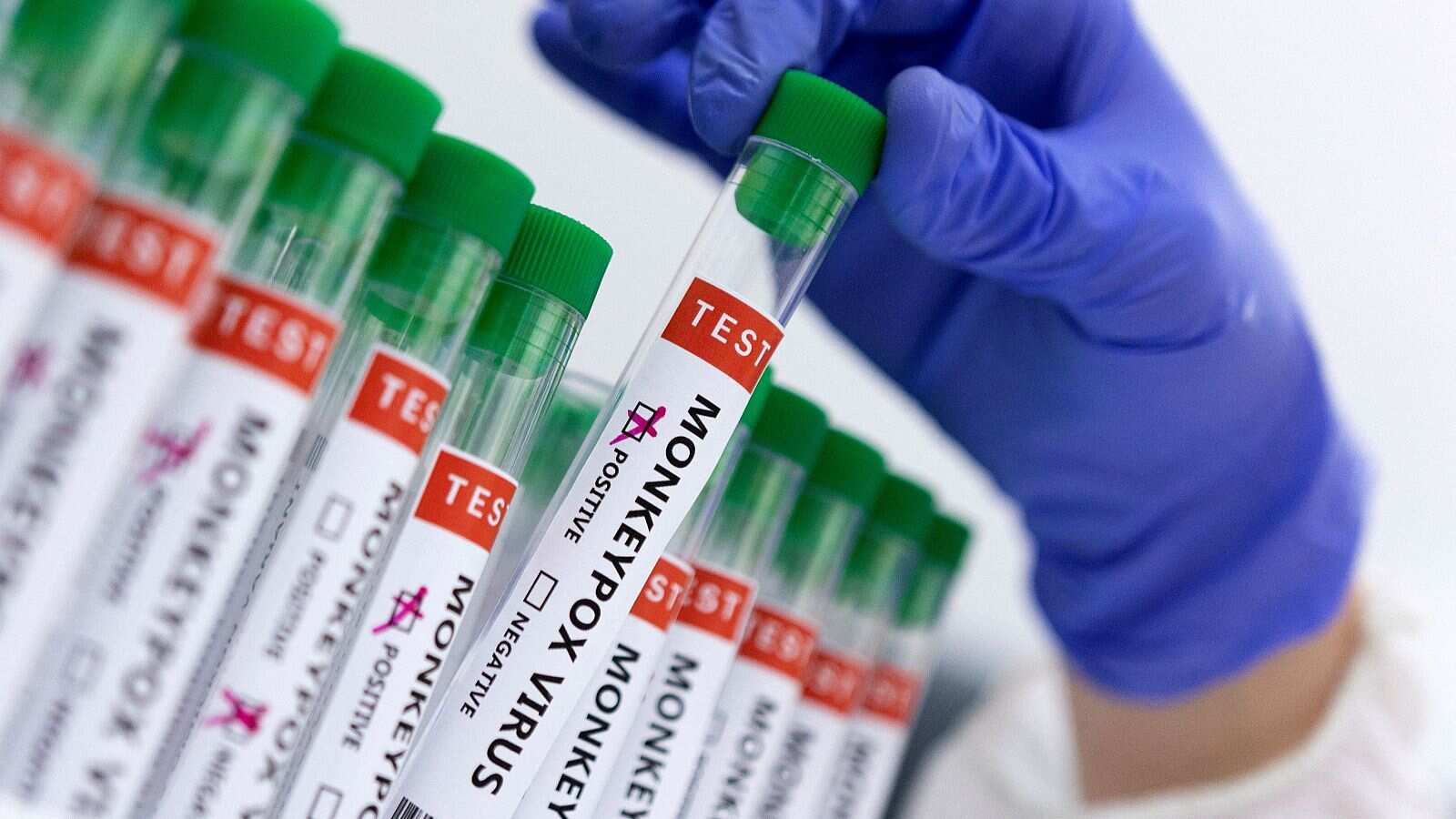 Imagen referencial de un test de la viruela del mono