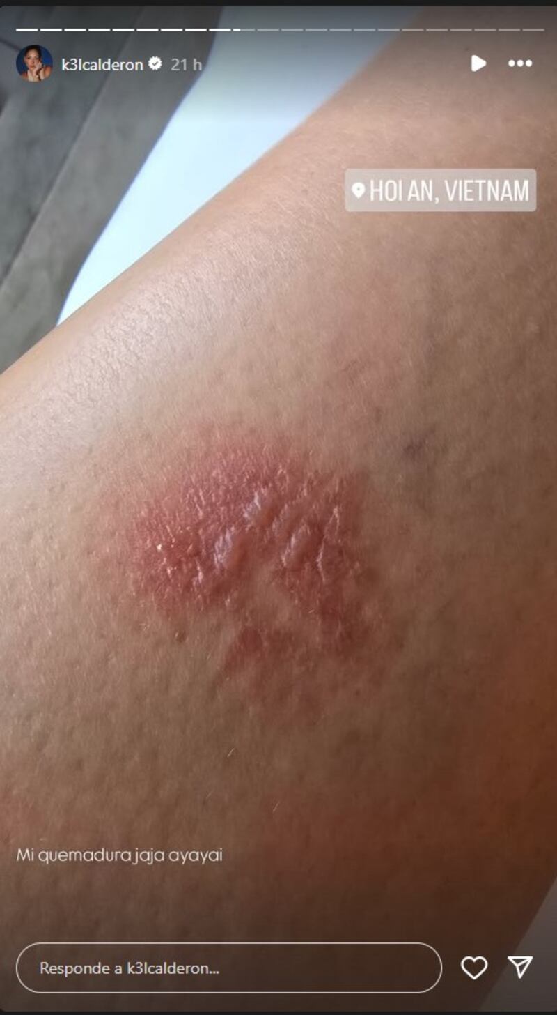 Kel Calderón sufrió accidente durante su recorrido por Vietnam y compartió imágenes de la lesión: “Mucho cuidado con las motos”