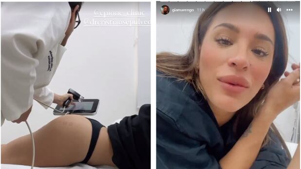 A través de sus historias de Instagram, la ex Aquí se Baila compartió videos desde un centro médico dando detalles del particular tratamiento que se realizó en su zona trasera.
“Es un tratamiento que se llama Morpheus que quiero compartir con ustedes porque @Drcristiansepulveda me aseguró que es un procedimiento súper seguro y con muy buenos resultados para la parte del potito y del banana roll (ese rollito que se forma debajo del cachetin)”, señaló mientras le ponían unas vendas en el trasero.