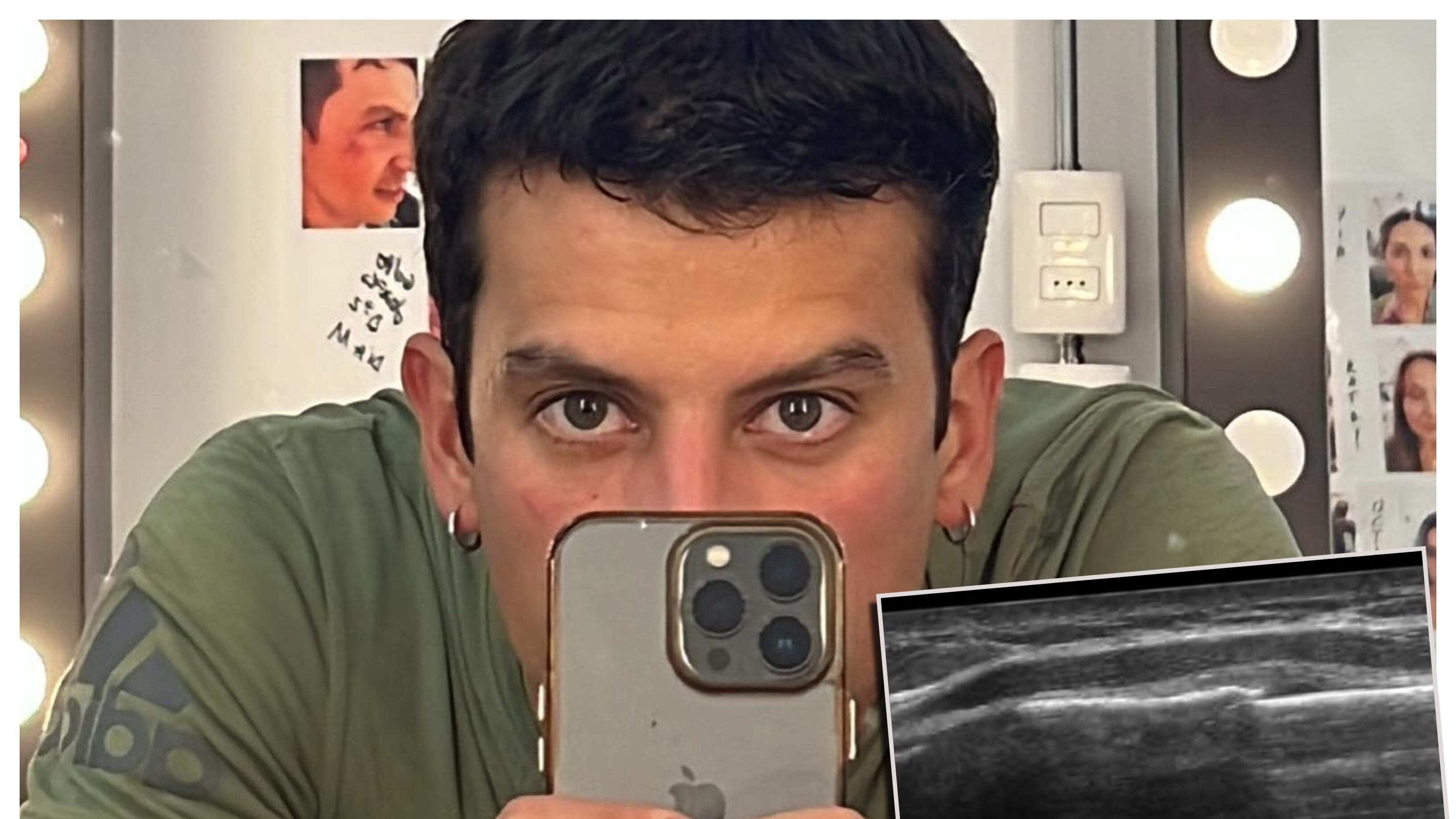 El actor de "Como la vida misma" dio cuenta este fin de semana de su proceso de recuperación de la fractura de costillas sufrida hace cerca de dos meses.