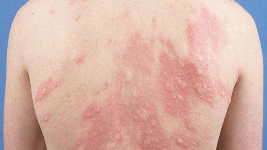 Cuando una persona tiene urticaria por frío se le suele colocar roja la piel.