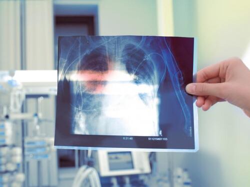 La silicosis afecta a trabajadores de construcción, ¿es mortal?