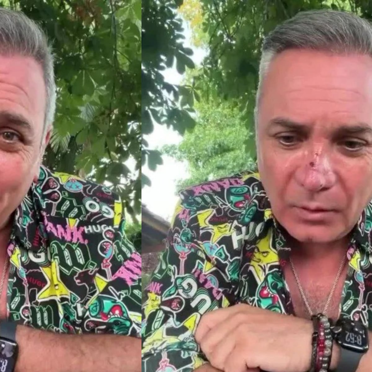 Luis Jara revela mordedura de perro en el rostro Luis Jara revela mordedura de perro en el rostro