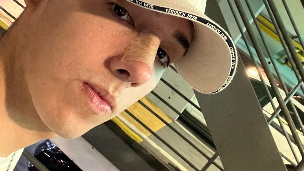 El artista urbano se dejó ver con el resultado final de su cirugía estética.