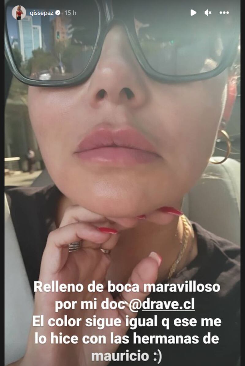 La ex panelista de TNT Sports llamó la atención de la web tras compartir en sus redes sociales registros de un tratamiento estético que probó para mejorar su aspecto físico.
A través de sus historias de Instagram la ex de Mauricio Pinilla compartió registros en un centro de estética donde reveló que probó un procedimiento para mejorar sus labios.
“Estoy donde mi doctora preferida… tengo ahí un poquito morado… porque la semana pasada me saqué toda la boca porque me la quiero hacer de nuevo con ella para que me la haga bien, super, super bien, gordita y todo así que ahora les voy a mostrar”, expresó la comunicadora.
“TENGO MORADO SOLAMENTE”
“Me puso hialuronidasa que te saca todo, no les voy a mostrar sin filtro porque tengo morado solamente”, explicó Gissella Gallardo compartiendo posteriormente un registro de sus labios.
“Relleno de boca maravilloso por mi doc @drave.cl. El color sigue igual que ese que me lo hice con las hermanas de Mauricio”, agregó con una carita feliz refiriéndose a un tratamiento que probó en el pasado con sus excuñadas.