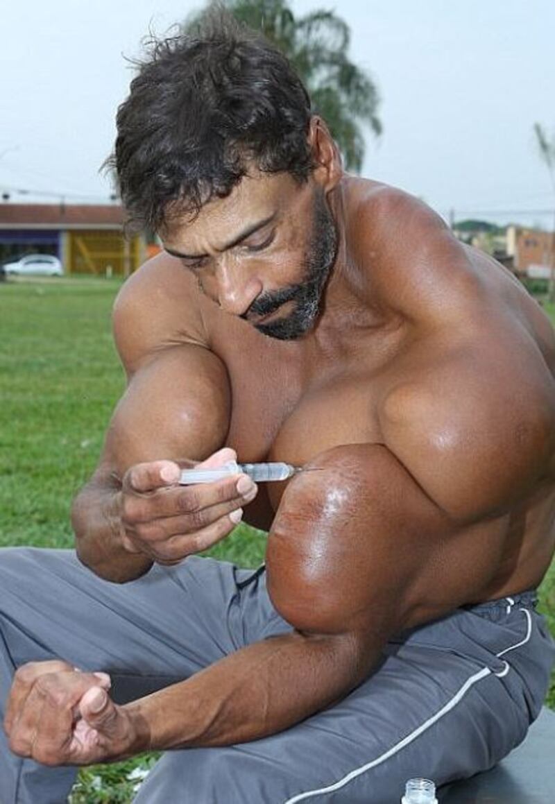 Murió Valdir Segato, el “Hulk brasileño” que se inyectaba peligrosa sustancia para hacer crecer sus músculos