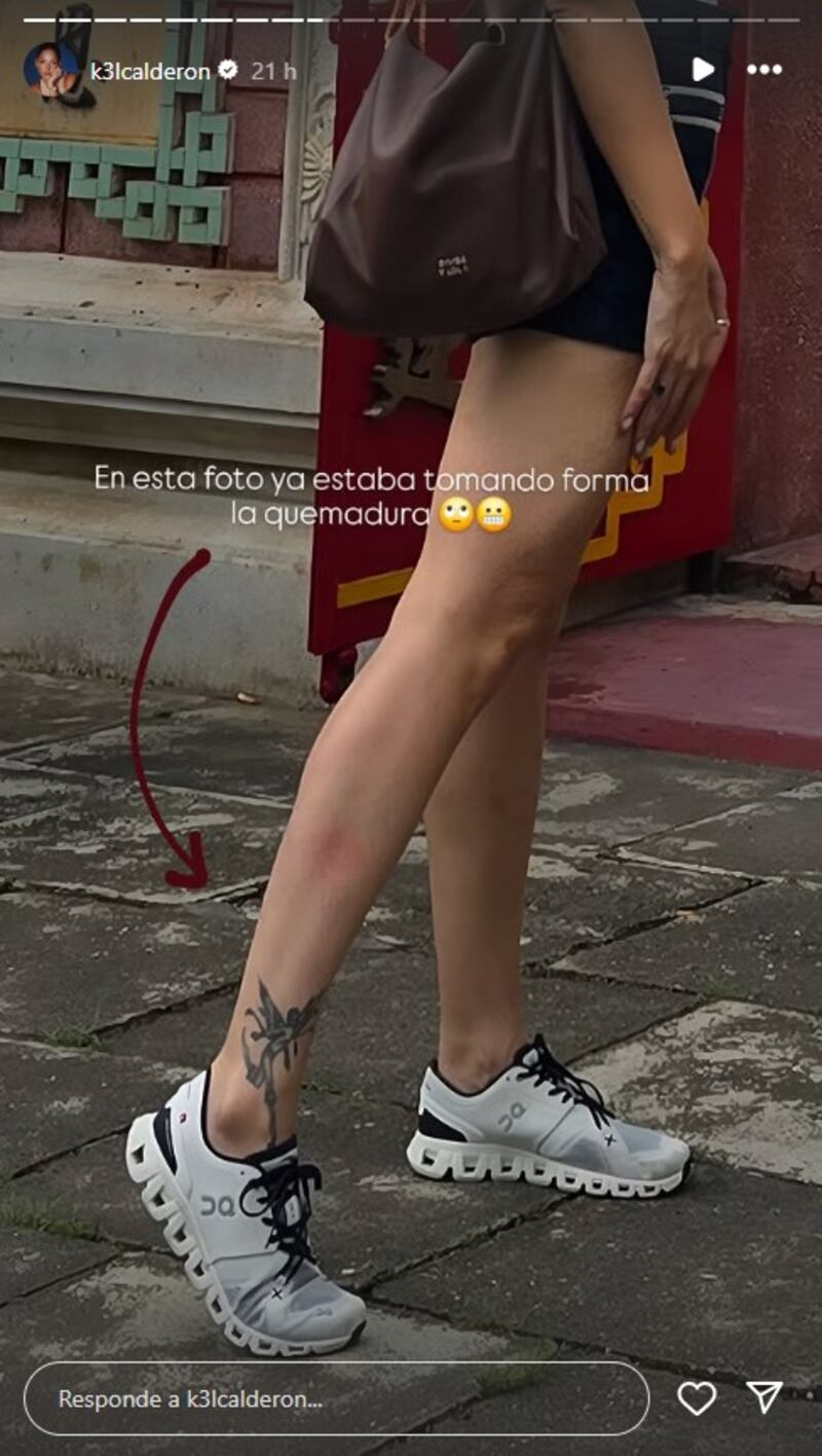 Kel Calderón sufrió accidente durante su recorrido por Vietnam y compartió imágenes de la lesión: “Mucho cuidado con las motos”