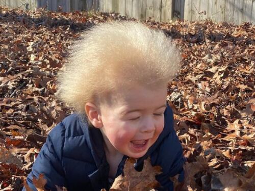 El curioso caso de Lockan, el niño que sufre el “Síndrome del pelo impeinable”