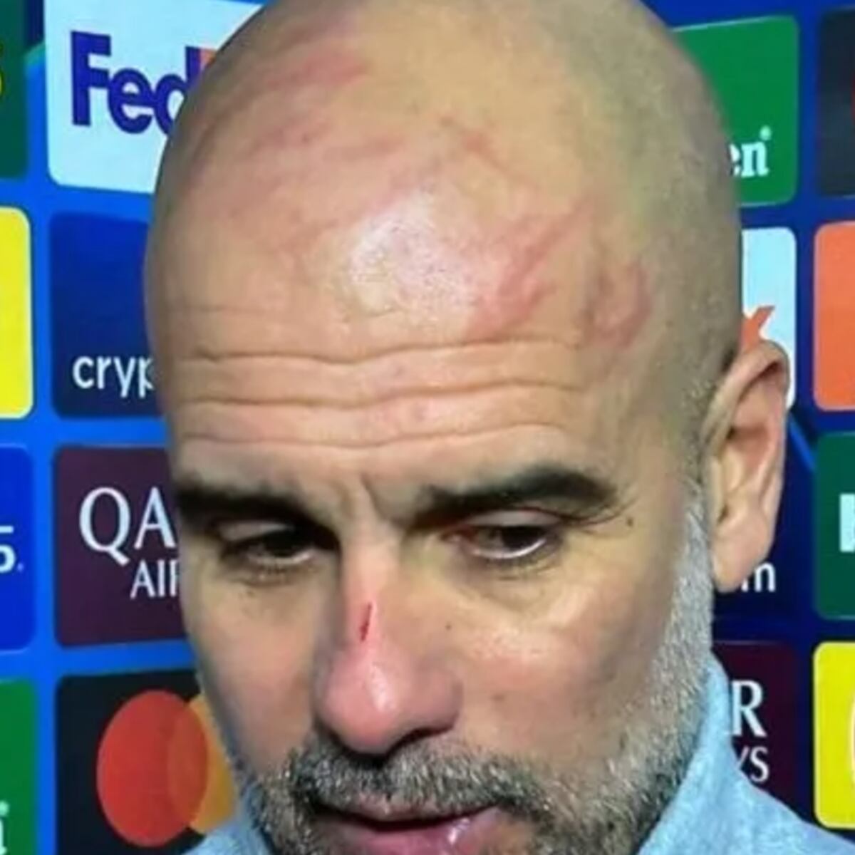 Guardiola sufre impactantes heridas tras empate del City Guardiola sufre impactantes heridas tras empate del City