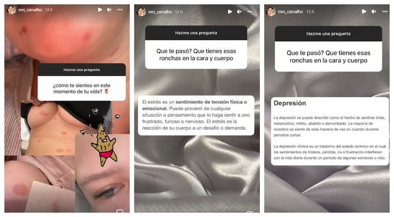 Michelle Carvalho padece de Pitiriasis Rosada.