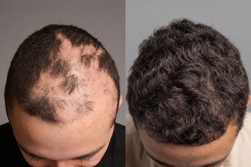 Cirugía que cambia vidas: implante capilar gratuito reconstruye la autoestima de niños quemados