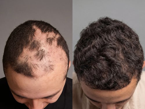 Cirugía que cambia vidas: implante capilar gratuito reconstruye la autoestima de niños quemados