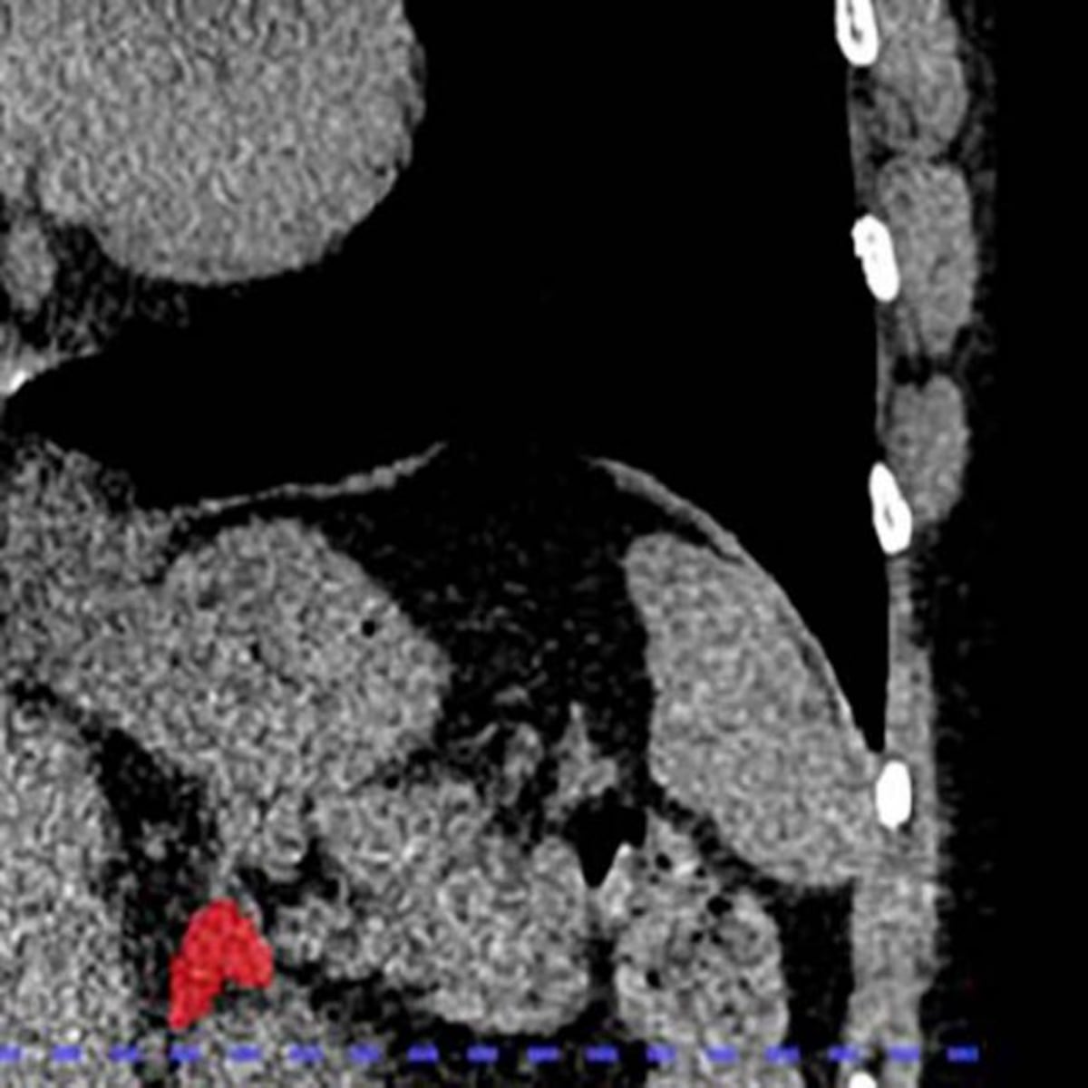 IA revela biomarcador para detectar estrés crónico IA revela biomarcador para detectar estrés crónico