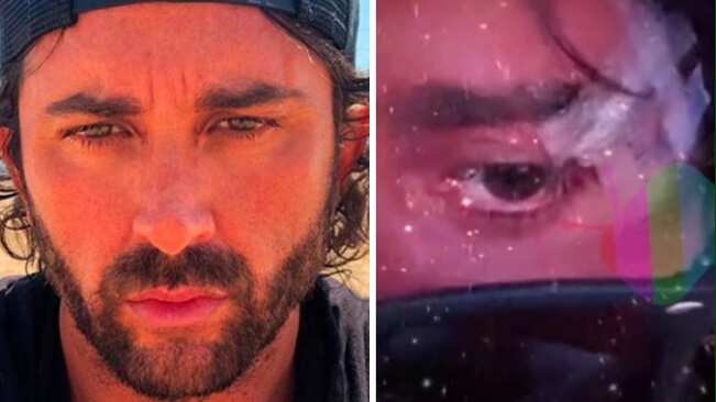 “Llega una doctora y me dice: ‘Un millón de pesos por los dos puntos’. Lo podré pagar, pero esa hu... era una estafa. Esperé una hora más y no llegaba nadie, así que pesqué mis hue... y me fui. En mi casa me puse de esos parches que cierran las heridas”, complementó indignado.