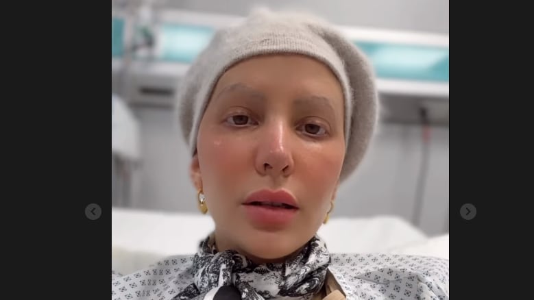 Aylén Milla entregó detalles del nuevo procedimiento médico al cual fue sometida, tras terminar con sus 13 quimioterapias, en su lucha por vencer el cáncer de mama triple negativo que le fue diagnosticado en noviembre del año 2022.
“Empezamos a la madrugada. Primero, me hicieron una marcación en la mama (…) dolió mucho para ser sincera”, afirmó.
La modelo argentina y exchica reality reveló que la intervención fue más compleja de lo que creía.
“Yo pensaba que era una marcación con un Sharpie, pero no era solo eso (…) me pusieron unos alambres, fue lo más feo de este tratamiento de meses”, consignó Página 7.
De igual forma, agradeció la dedicación y cuidados de las especialistas.
“Creo que la parte de donde más sufrí fue la marcación, igual las chicas fueron un amor y lo más cuidadosas. Chicos, me ponían tres alambres adentro de la mama”, agregó.
Aylén Milla explica procedimiento
“Te sientan en un mamógrafo, te aprietan la mama bien fuerte (…) de repente me miro y veo tres alambres salidos de mi pecho todo ensangrentado, era horrible”.
“No le deseo a nadie esto, pero quería contar también un poco de la realidad. Si bien siempre soy optimista y mi umbral de dolor es muy alto, esas son una de las cosas que más me dolió”, añadió en una de sus historias de Instagram.
“Fue doloroso, horrible y me puse a llorar cuando vi todo eso. Tenía como sensación de desmayarme mientras me estaban haciendo ese tratamiento, porque primero me ponen tres pinchazos de anestesia y después tres pinchazos extrañísimos. Fue un poco terrible, pero ya estoy bien”, afirmó.
“Lo de la mama salió todo bien (…) el cirujano que me operó fue un amor, porque no me duele nada”, concluyó.