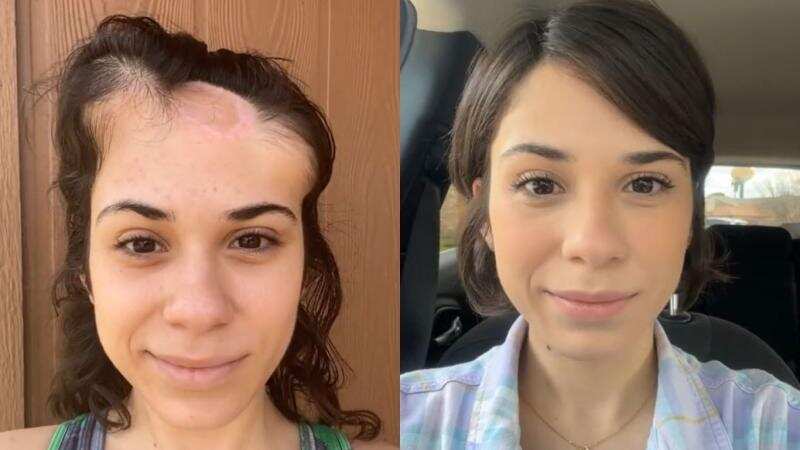 Sobreviviente al cáncer de piel comparte su increíble proceso de recuperación