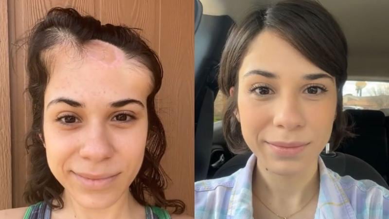 Sobreviviente al cáncer de piel comparte su increíble proceso de recuperación