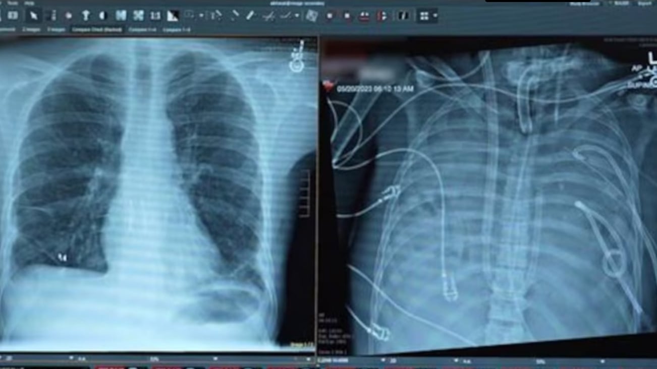 La historia del hombre que vivió 48 horas sin pulmones