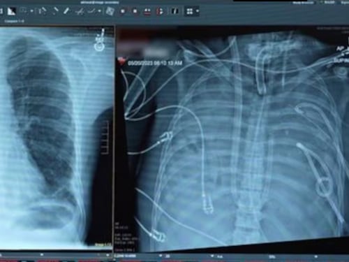 La historia del hombre que vivió 48 horas sin pulmones