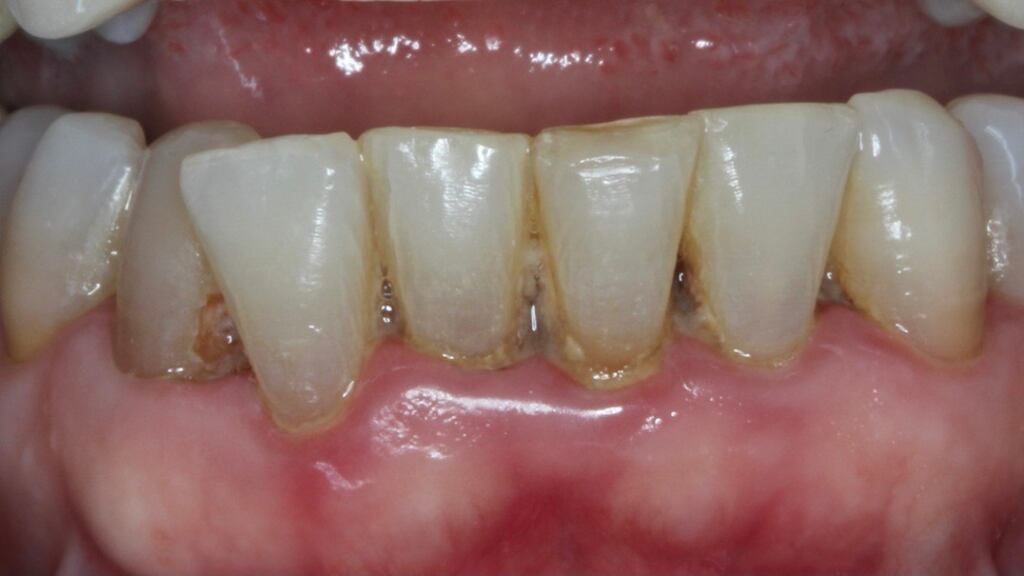 El sarro en los dientes es placa bacteriana.