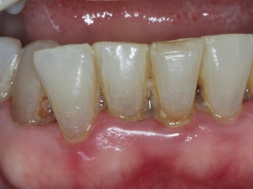 Una enfermedad bucal provoca la muerte de exjugador de la NFL