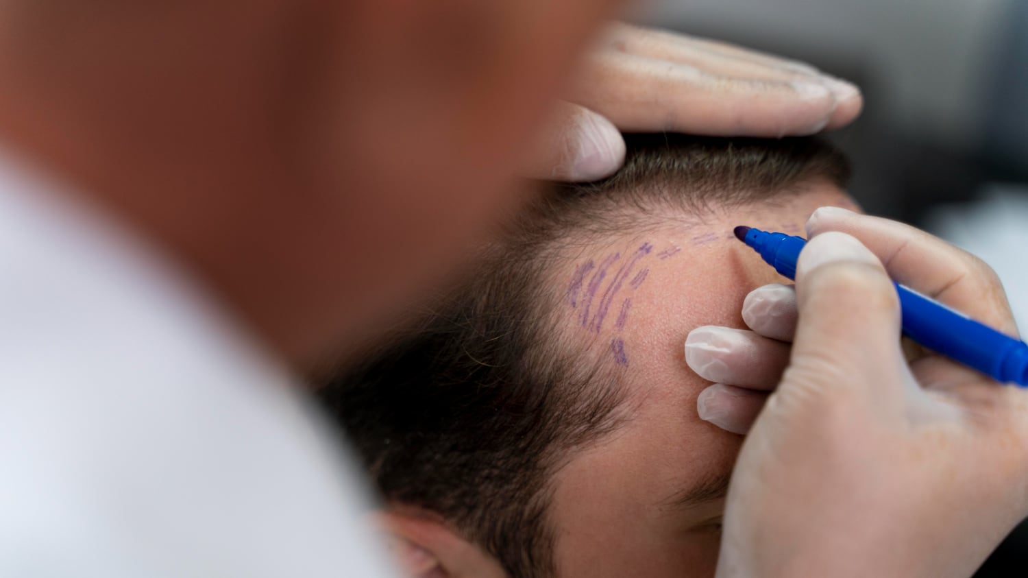Los tratamientos para la alopecia van al alza