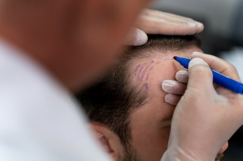 De frenar la caída del cabello a revertirla: cómo la medicina regenerativa abre nuevas alternativas en el tratamiento de la alopecia