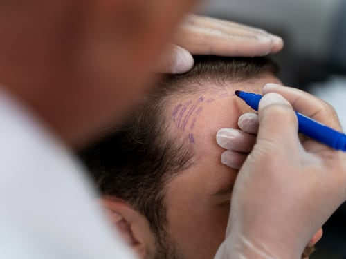 De frenar la caída del cabello a revertirla: cómo la medicina regenerativa abre nuevas alternativas en el tratamiento de la alopecia