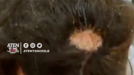 Quemadura en peluquería