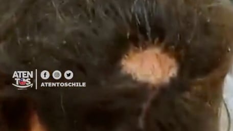 Quemadura en peluquería