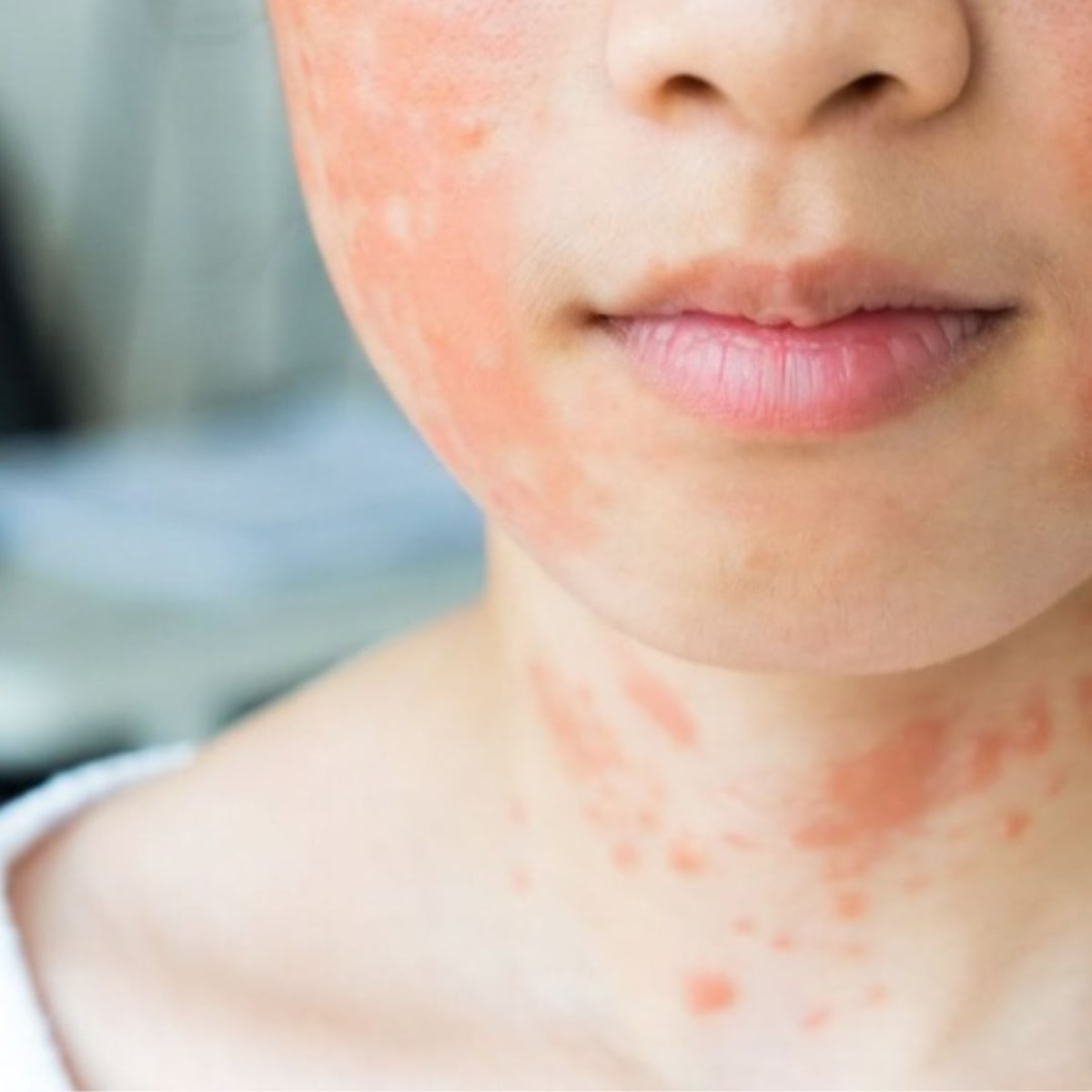 Sarampión en Región Metropolitana: síntomas y prevención Sarampión en Región Metropolitana: síntomas y prevención