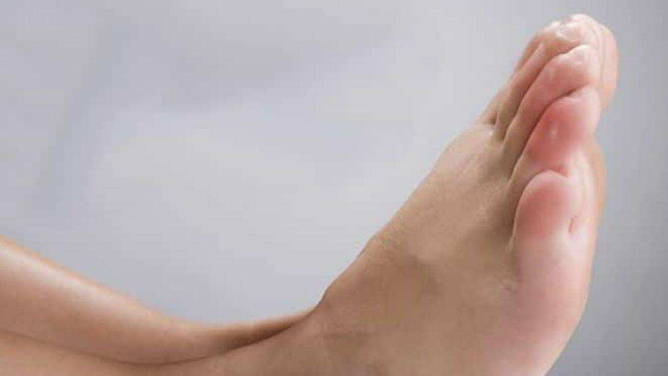 Las personas con pies hinchados deben acudir a un especialista.