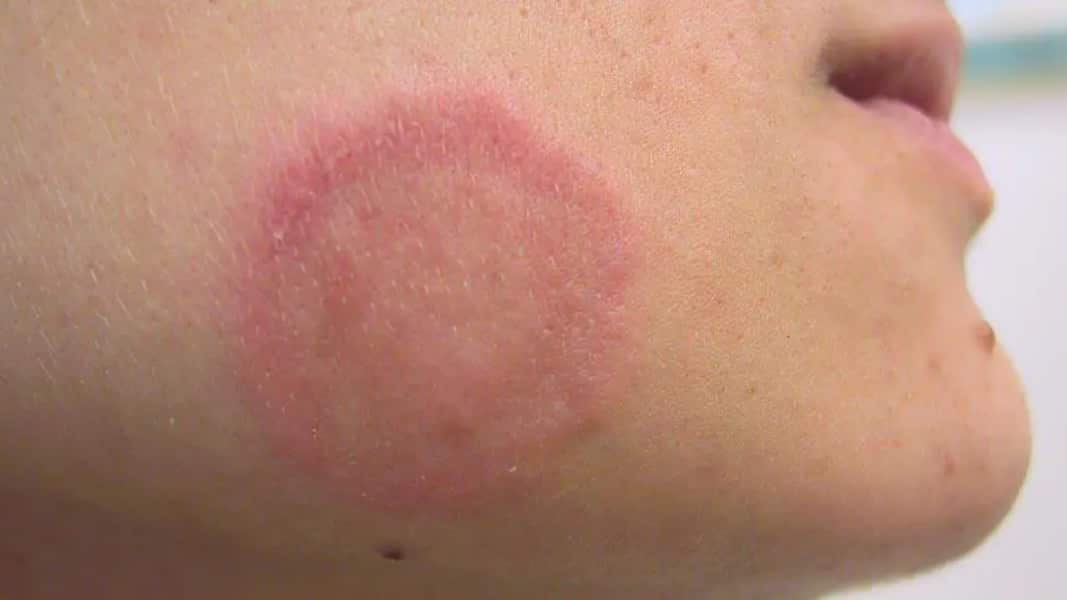 Los casos detectados en Nueva York se relacionan con la Tiña que causa erupciones rojas en la piel.