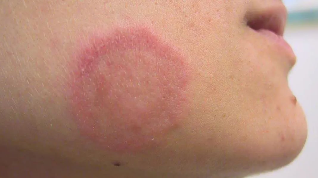 Los casos detectados en Nueva York se relacionan con la Tiña que causa erupciones rojas en la piel.