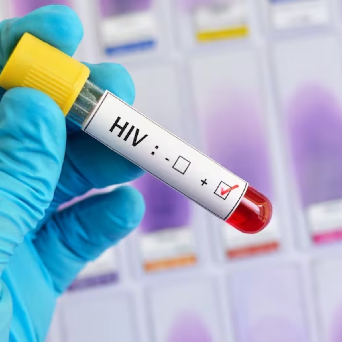 Preocupación en Chile por aumento de casos de VIH en jóvenes Preocupación en Chile por aumento de casos de VIH en jóvenes
