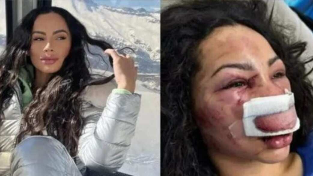 Brasileña agredida en Las Condes.